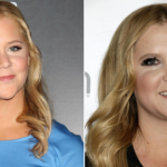 Amy Schumer cushing's syndrome