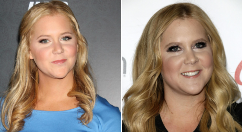 Amy Schumer cushing's syndrome