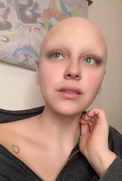 Boyfriend grows hair for girlfriend with alopecia