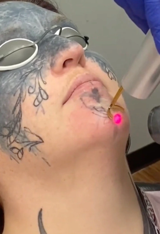 Face tattoo removal