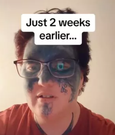 Face tattoo removal