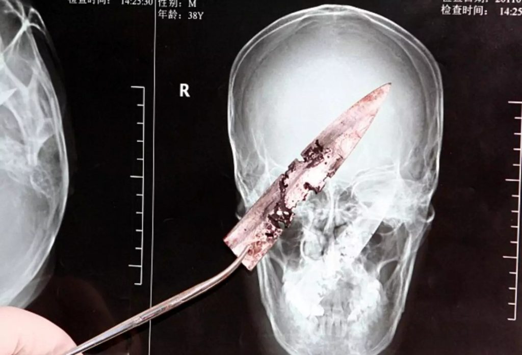 Knife in head surgery 4 years
