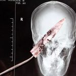 Knife in head surgery 4 years
