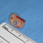 Tooth-in-eye surgery