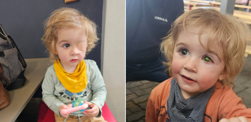 Toddler eye infection from kiss