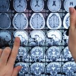 Nurse Brain Tumor Cluster