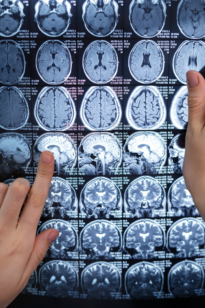 Nurse Brain Tumor Cluster