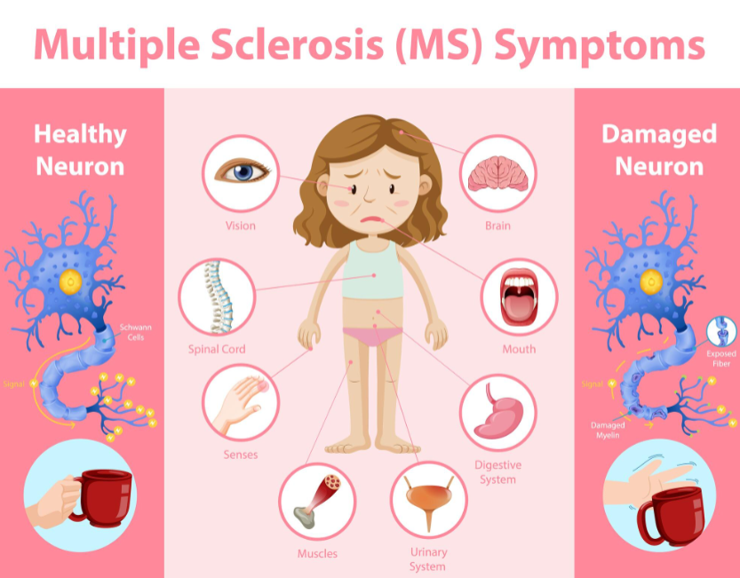 sclerosis