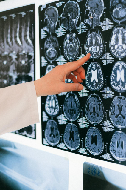 alzheimer