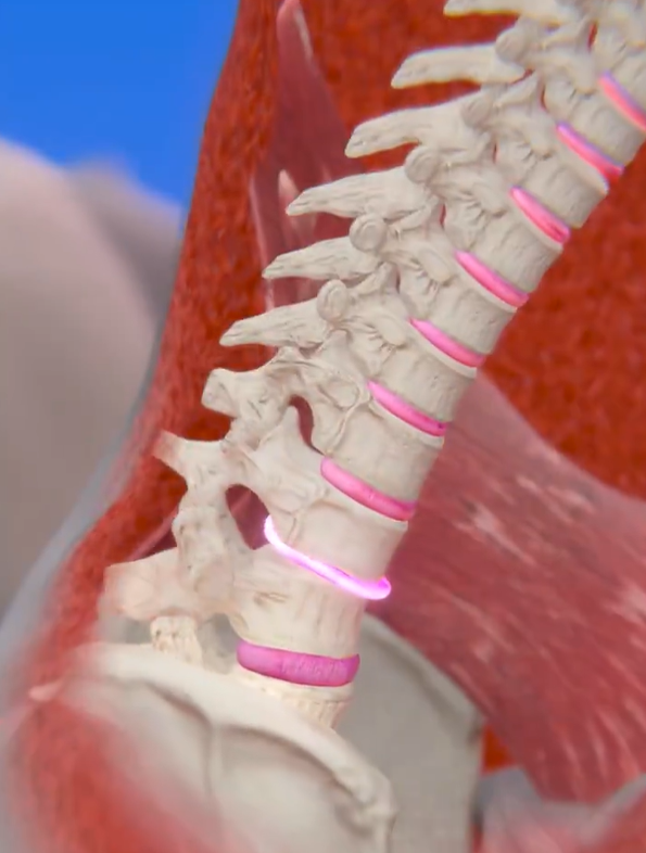 Woman Paralyzed After Sneeze