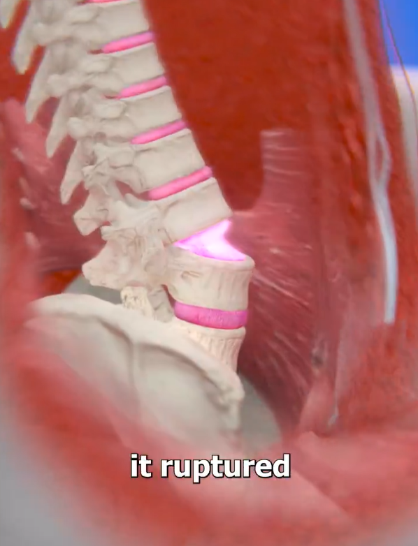 Public stunned by rare case of woman paralyzed after sneeze, raising health concerns