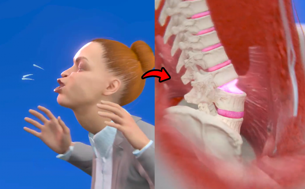 Woman Paralyzed After Sneeze