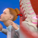 Woman Paralyzed After Sneeze