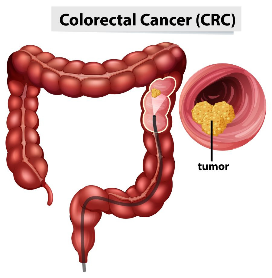 Colon Cancer Awareness