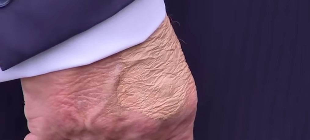 Chronic Venous Insufficiency