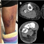 Flesh-eating bacteria in Florida
