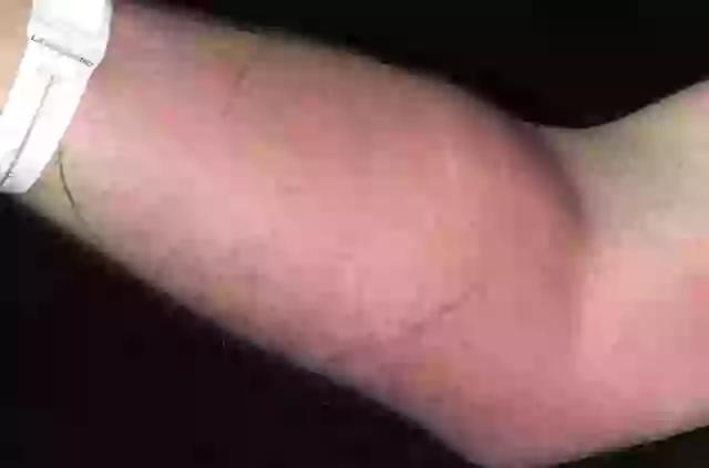 Self-Administered Semen Injection