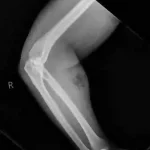 Self-Administered Semen Injection