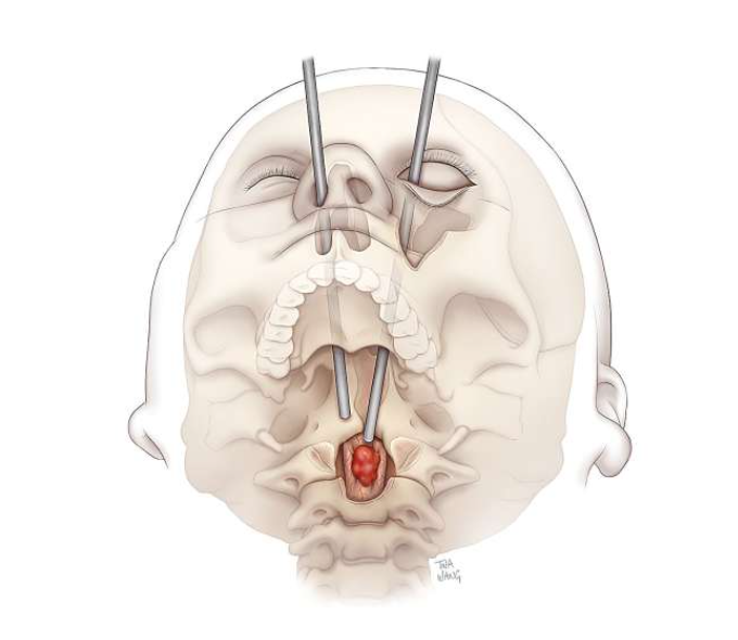 Spinal Tumor Removal Through Eye Socket