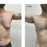 breast reduction men
