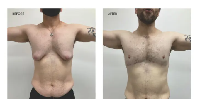 breast reduction men
